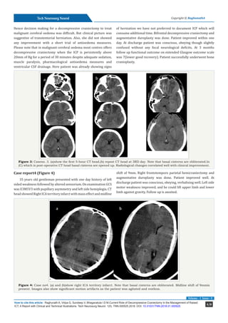 Current Role of Decompressive Craniectomy In the Management of Raised ICT; A Report with Clinical and Technical Illustrations_CRimson Publishers