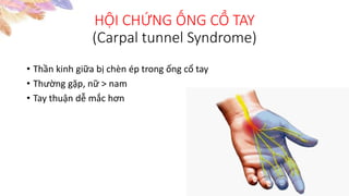 • Thần kinh giữa bị chèn ép trong ống cổ tay
• Thường gặp, nữ > nam
• Tay thuận dễ mắc hơn
HỘI CHỨNG ỐNG CỔ TAY
(Carpal tunnel Syndrome)
 