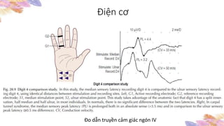 Điện cơ
Đo dẫn truyền cảm giác ngón IV
 