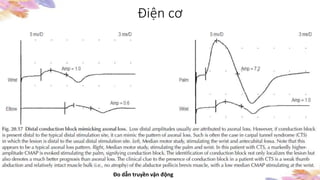 Điện cơ
Đo dẫn truyền vận động
 