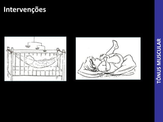 Intervenções
TÔNUSMUSCULAR
 