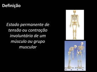 Definição
Estado permanente de
tensão ou contração
involuntária de um
músculo ou grupo
muscular
 