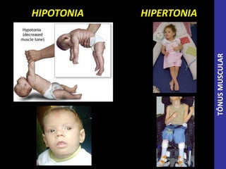 HIPOTONIA HIPERTONIA
TÔNUSMUSCULAR
 
