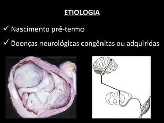 ETIOLOGIA
 Nascimento pré-termo
 Doenças neurológicas congênitas ou adquiridas
 