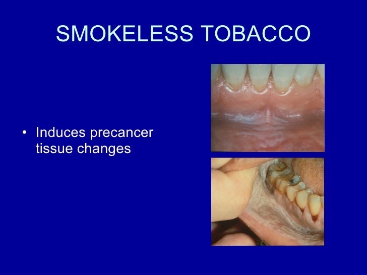 Tobacco and Oral Health