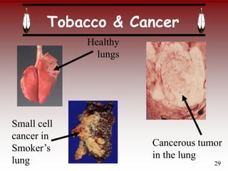 Tobacco & Cancer
Cancerous tumor
in the lung
Small cell
cancer in
Smoker’s
lung
Healthy
lungs
29
 