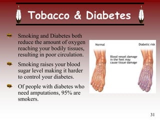 Tobacco & Diabetes
Smoking and Diabetes both
reduce the amount of oxygen
reaching your bodily tissues,
resulting in poor circulation.
Smoking raises your blood
sugar level making it harder
to control your diabetes.
Of people with diabetes who
need amputations, 95% are
smokers.
31
 
