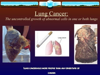 Lung Cancer: The uncontrolled growth of abnormal cells in one or both lungs Lung cancer kills more people than any other type of cancer 