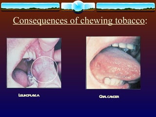 Consequences of chewing tobacco : Leukoplakia Oral cancer 