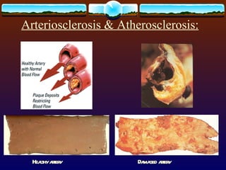 Arteriosclerosis & Atherosclerosis:   Healthy artery Damaged artery 