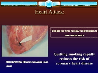 Heart Attack:   Quitting smoking rapidly reduces the risk of coronary heart disease Torn heart wall: R esult of over-worked heart muscle Smokers are twice as likely as Nonsmokers to have a heart attack 
