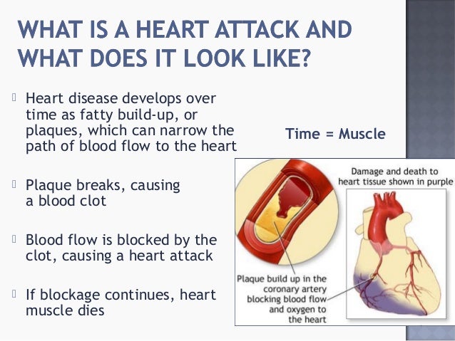 Symptoms of heart attack & warning signs may vary in men ...