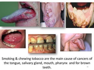 Smoking & chewing tobacco are the main cause of cancers of
the tongue, salivary gland, mouth, pharynx and for brown
teeth. 46
 