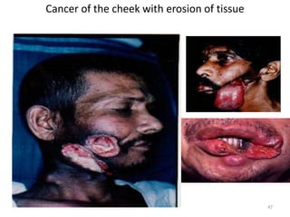 Cancer of the cheek with erosion of tissue
47
 