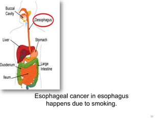 Esophageal cancer in esophagus
happens due to smoking.
50
 