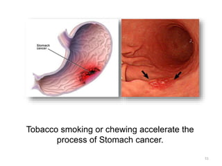 Tobacco smoking or chewing accelerate the
process of Stomach cancer.
51
 