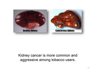 Kidney cancer is more common and
aggressive among tobacco users.
52
 