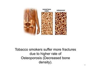 Tobacco smokers suffer more fractures
due to higher rate of
Osteoporosis (Decreased bone
density).
54
 