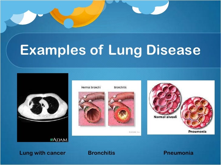 Tobacco and lung disease