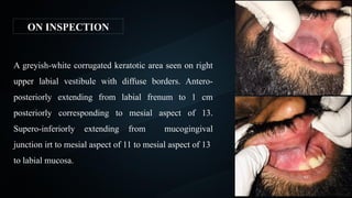 Diffuse Borders A CASE OF TOBACCO POUCH KERATOSIS in oral cavity.pptx