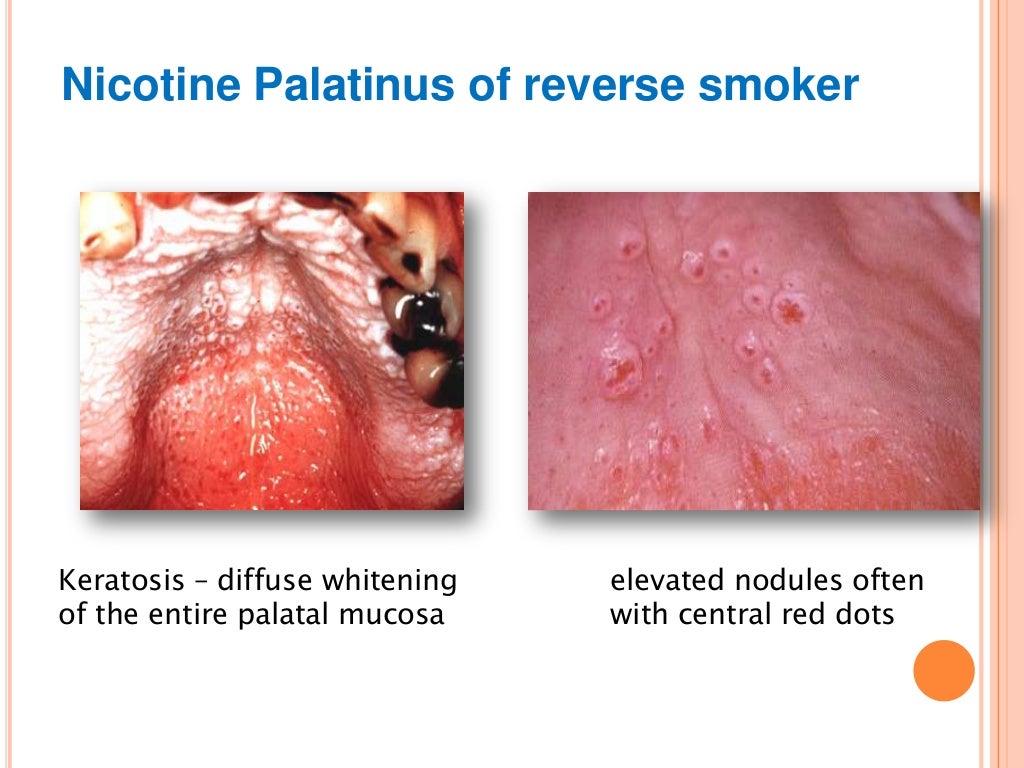 Tobacco smoking & oral cancer