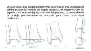 Angulo Tobillo tobilloclaselisto manejo y tratamiento.pptx