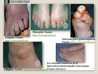 “Curso de Anatomía Humana:
      Carrera de Médico Cirujano”




                                    Tiña pedis. Fuente:
                                    http://www.dermis.net
Erisipela. Fuente:
                                                            Infección grave gram negativos.
http://www.dermis.net
                                                            Fuente: http://www.dermis.net




                                       Los xantomas tendinosos de la
                                       hipercolesterolemia familiar heterocigota.
Ganglión. Fuente: http://www.dermis.netFuente: elsevier.es                             34
 