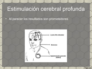 Estimulación cerebral profunda
• Al parecer los resultados son prometedores
 