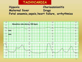 Tocodynamometer Variations Tocodynamometer, cardiotocogram | PPTX