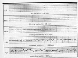 Tocodynamometer Variations Tocodynamometer, cardiotocogram | PPTX