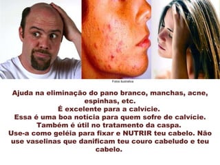 Ajuda na eliminação do pano branco, manchas, acne, espinhas, etc. É excelente para a calvície.  Essa é uma boa notícia para quem sofre de calvície. Também é útil no tratamento da caspa.  Use-a como geléia para fixar e NUTRIR teu cabelo. Não use vaselinas que danificam teu couro cabeludo e teu cabelo.  Fotos ilustrativa 