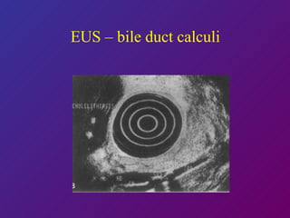 EUS – bile duct calculi 