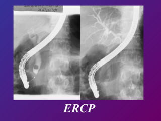 ERCP 