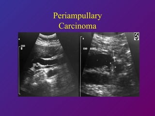 Periampullary Carcinoma 