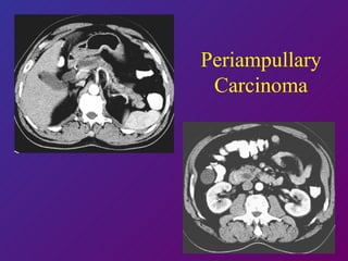 Periampullary Carcinoma 