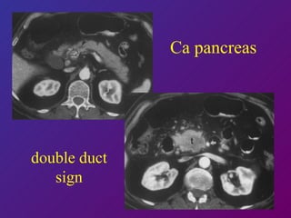 Ca pancreas double duct sign 