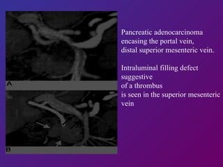 Pancreatic adenocarcinoma encasing the portal vein, distal superior mesenteric vein.  Intraluminal filling defect suggestive  of a thrombus  is seen in the superior mesenteric vein 