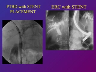 PTBD with STENT PLACEMENT   ERC with STENT 