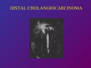 DISTAL CHOLANGIOCARCINOMA 
