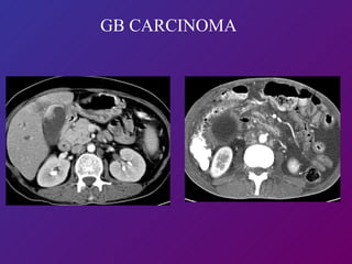 GB CARCINOMA 