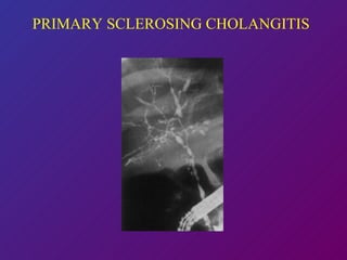 PRIMARY SCLEROSING CHOLANGITIS 