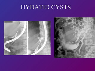 HYDATID CYSTS 