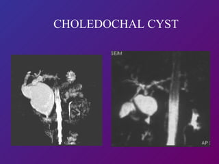 CHOLEDOCHAL CYST 