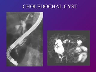 CHOLEDOCHAL CYST 