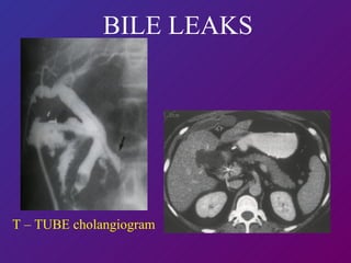 T – TUBE cholangiogram BILE LEAKS 