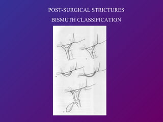 POST-SURGICAL STRICTURES BISMUTH CLASSIFICATION 