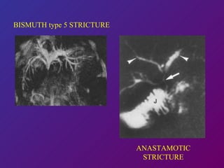 BISMUTH type 5 STRICTURE ANASTAMOTIC STRICTURE 