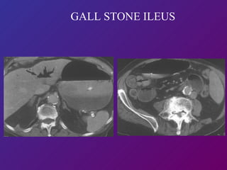 GALL STONE ILEUS 