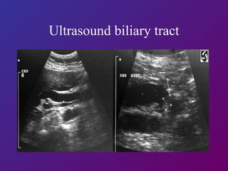 Ultrasound biliary tract 