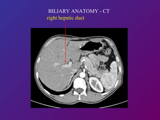   BILIARY ANATOMY - CT right hepatic duct 